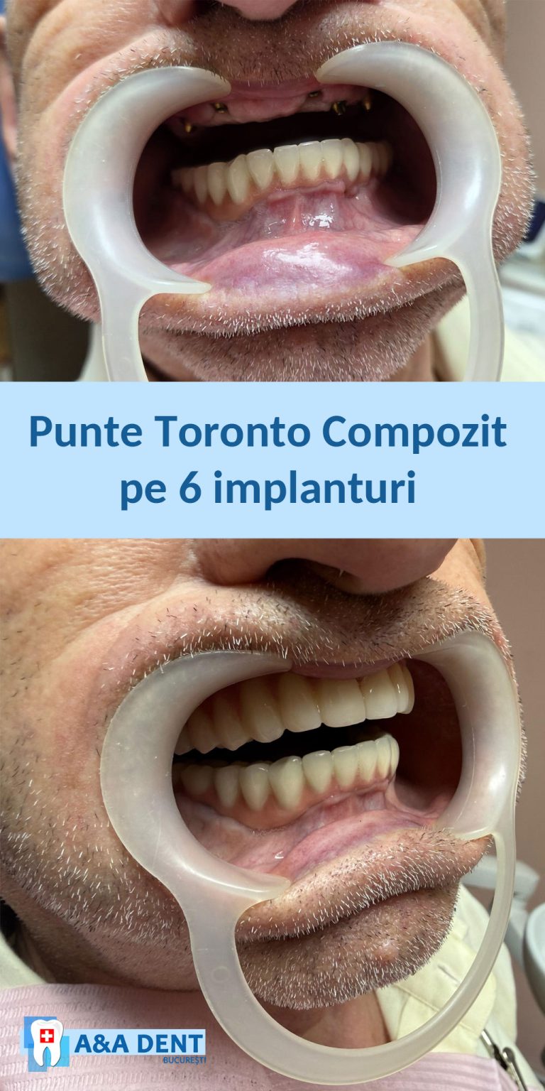 punte-toronto-compozit-pe-6-implanturi-aadent